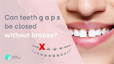 Why is it essential for teeth gap filling? - Aquafresh Prime