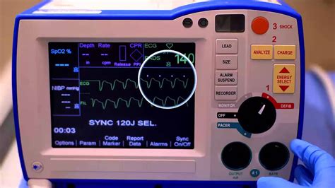 R Series Synchronized Cardioversion - YouTube