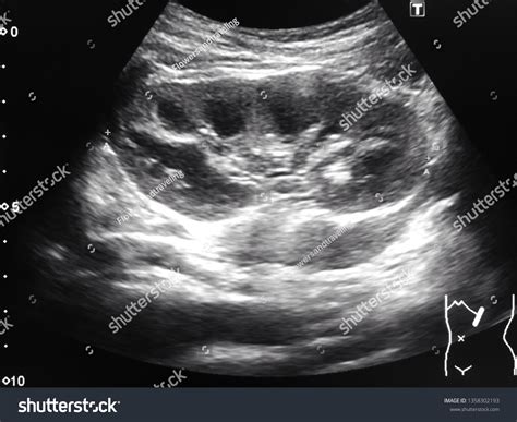 Normal Kidney Ultrasound