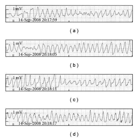 ECG appearance of Torsades de Pointes [10]. | Download Scientific Diagram