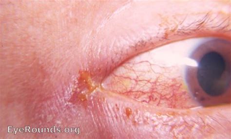 angular conjunctivitis. EyeRounds.org: Online Ophthalmic Atlas