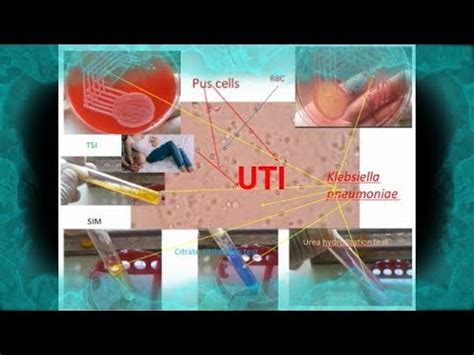 Pus cells ,Klebsiella in Urine of Urinary tract infection /UTI patient ...