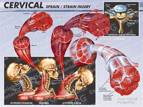 Cervical Sprain Strain Injury 2