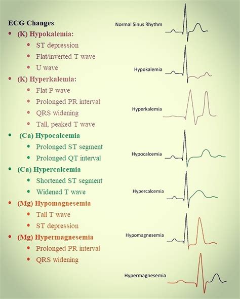 Hypomagnesemia Ecg