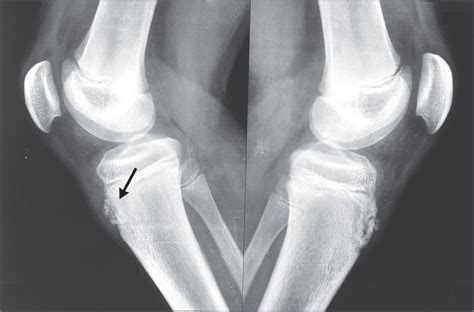 Osgood-Schlatters disease (OSD) | Medical Junction