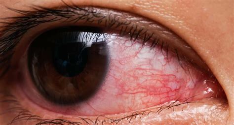 Causes of corneal ulcer | Pain, Redness, Light sensitivity and other ...