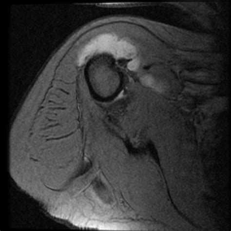 Bursitis MRI - wikidoc