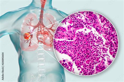 Lung cancer, 3D illustration and photo under microscope. Histopathology ...