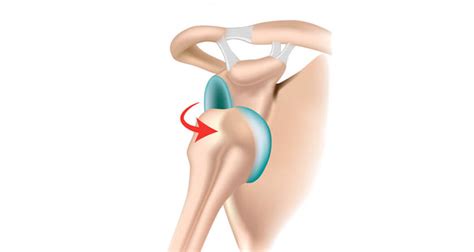 Shoulder Subluxation - Shoulder Instability - Symptoms, Causes, Exercises