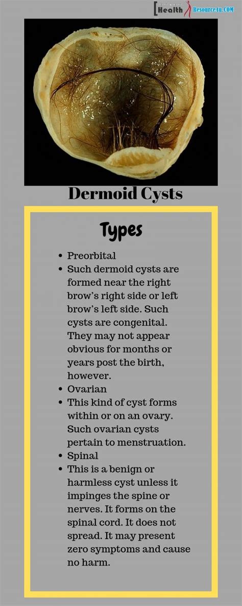 Dermoid Cyst: Causes, Pictures, Symptoms And Treatment