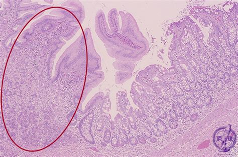 22.Pediatric pathology (5) Meckel diverticulum|Pathology Core Pictures