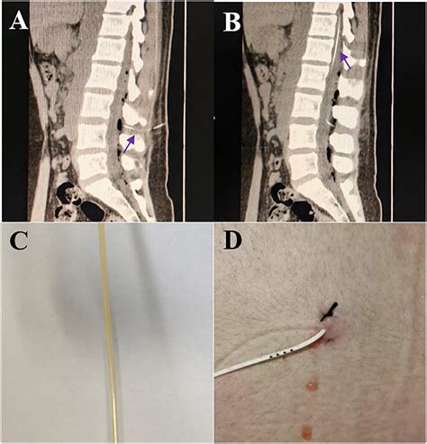 Frontiers | Analysis of risk factors and treatment strategies for lumbar cistern blockage after ...