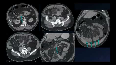 The Many Faces of Small Bowel Ischemia | Free Radiology CME - YouTube