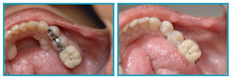 Tooth Colored Fillings Scarsdale | Ceramic Composite Restorations