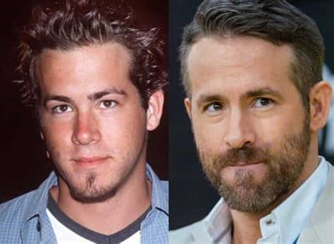 Ryan Reynolds Plastic Surgery: Nose Job, Botox and Hair Transplant