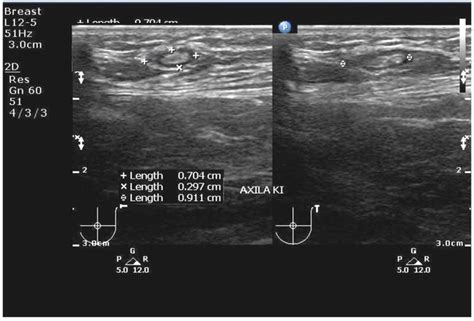 Ultrasound Examination of Gynecomastia Case in Male Patient: Case Report