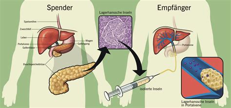 Inselzelltransplantation