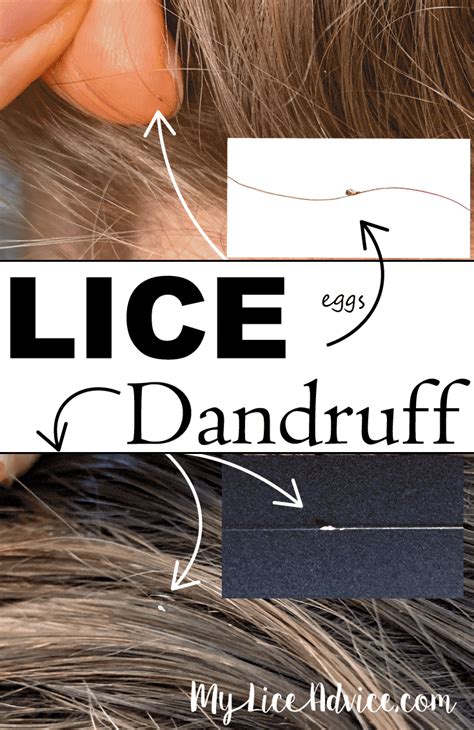 Lice vs Dandruff - 7 Key Differences Between Lice Eggs and Dandruff