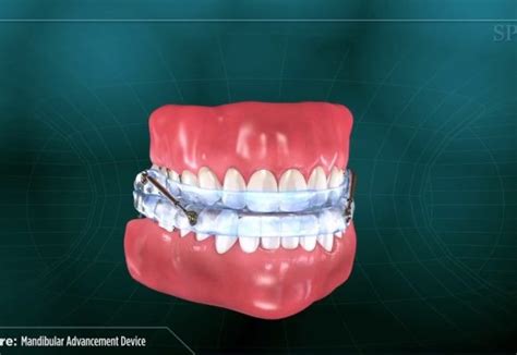 Mandibular Advancement Device - Oisterwijk