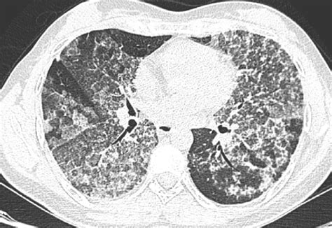 Bilateral diffuse ground-glass opacities with interlobular and... | Download Scientific Diagram