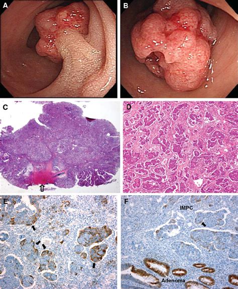 Colonoscopic findings and pathological features of invasive... | Download Scientific Diagram
