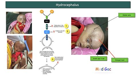 Hydrocephalus – Clinical features | Causes | Pathophysiology | Management – MediGac