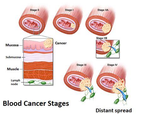 Blood Cancer – Types, Symptoms and Treatment