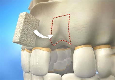 Bone Grafting Recovery - Avason Family Dentistry