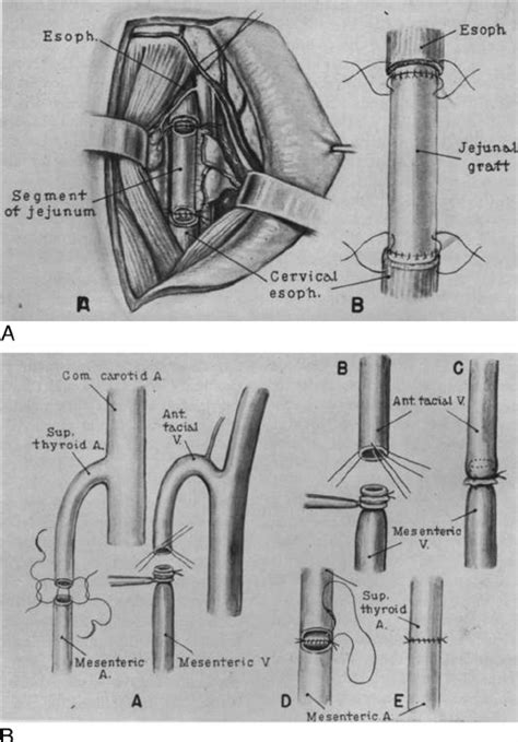 The first clinical ‘‘free tissue transfer’’; the autotransplantation of... | Download Scientific ...