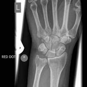 Ulnar styloid fracture | Radiology Reference Article | Radiopaedia.org