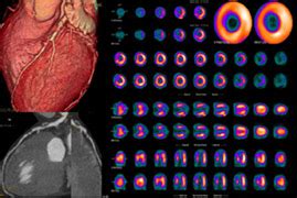 Cardiac PET Scan - Lim Ing Haan Cardiology Clinic