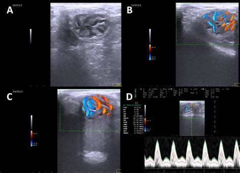 Representative ultrasound sonogram of the pampiniform plexus in ram... | Download Scientific Diagram