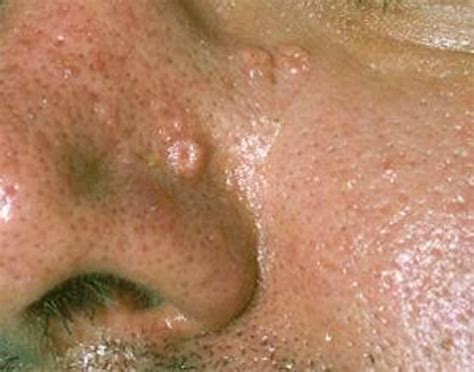 Sebaceous Hyperplasia - Pictures, Removal, Symptoms, Treatment, Causes