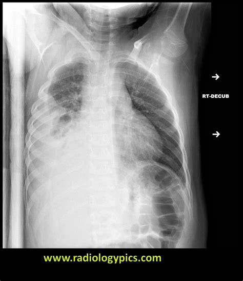 Solution to Unknown Case #23 – Empyema (loculated pleural effusion ...