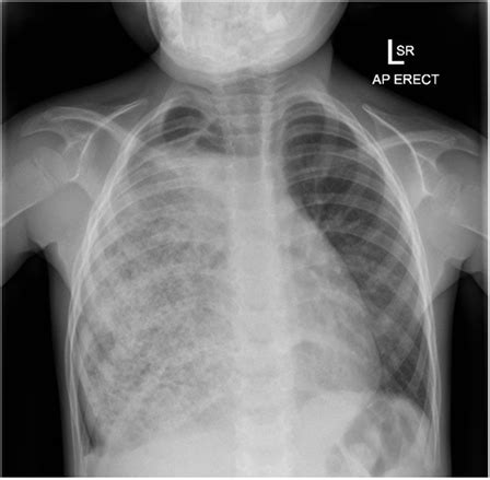 Frontiers | Giant Gastric Bezoar Complicating Congenital Esophageal Atresia Repaired by Gastric ...