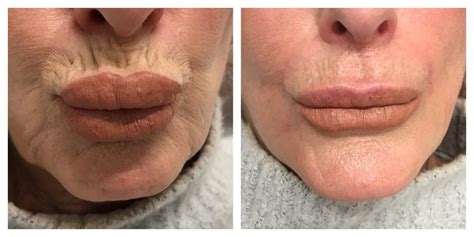 Before and After - Skin and Cosmetics Treatment