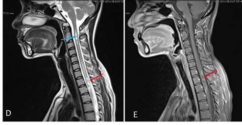 Neuromyelitis optica – Radiology Cases