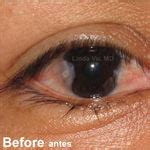 Pterygium Surgery Before & After Photos Monterey Park