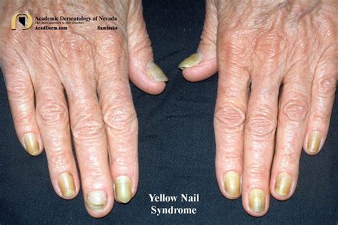 Yellow Nail Syndrome: Yellow Nails, Lymphedema, Bronchiectasis, Pleural ...