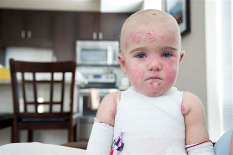 Epidermolysis Bullosa - Eb Disease | Paminaki Lovelly