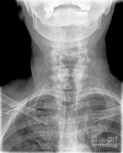 Cervical spine arthritis x ray - teachmens