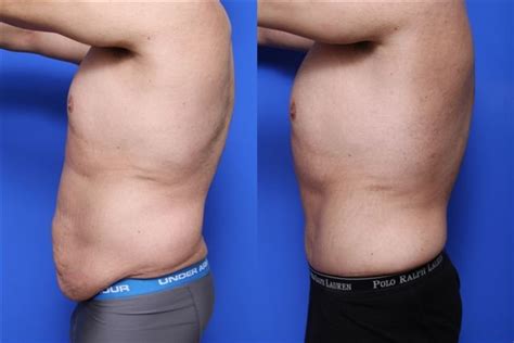 Tummy Tuck Before and After