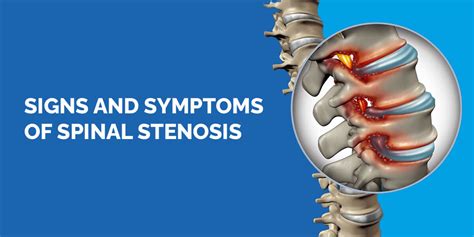 Signs and Symptoms of Spinal Stenosis