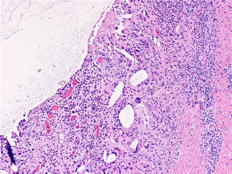 Epidermal Inclusion Cyst Histology