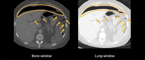 Abdominal CT: bowel perforation • LITFL • Radiology Library