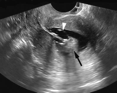 Abnormal Uterine Bleeding: The Role of Ultrasound | Obgyn Key