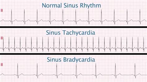 Sinus Tachycardia Vs Sinus Rhythm Top Sellers | www.jkuat.ac.ke