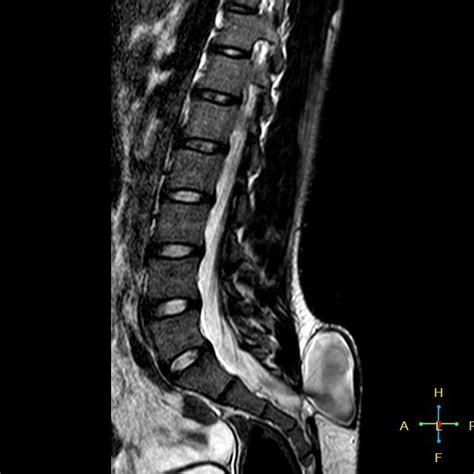 Imaging In Spinal Dysraphism And Myelomeningocele Overview | My XXX Hot ...