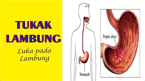 Radang Lambung Disebabkan Oleh – Sinau