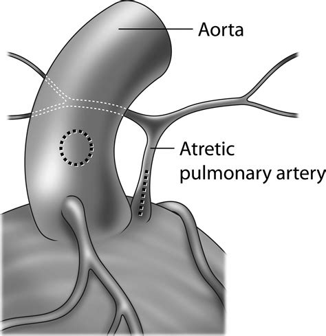 Pulmonary Atresia, VSD and Mapcas: Repair Without Unifocalization - Seminars in Thoracic ...